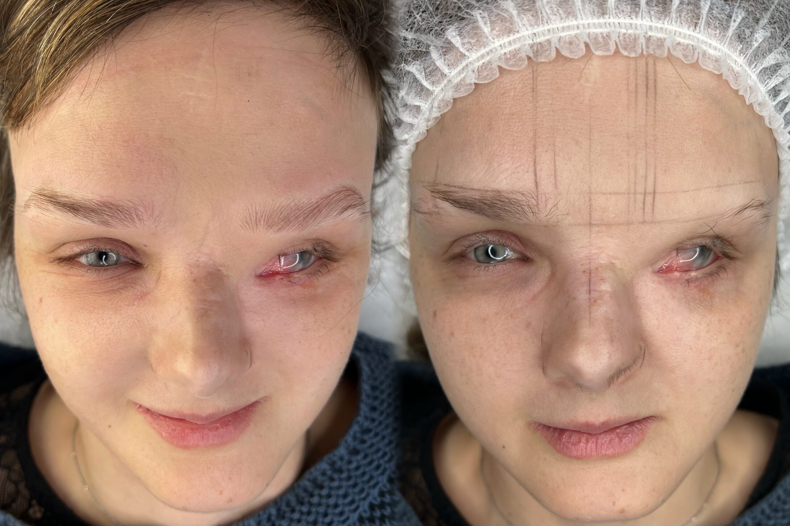 rekonstrukcja brwi metoda wlosa maszynowego krakow brwi wloskowe choroby genetyczne